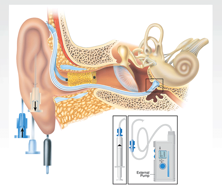 Color Illustration: Cochlear Micro-Catheter